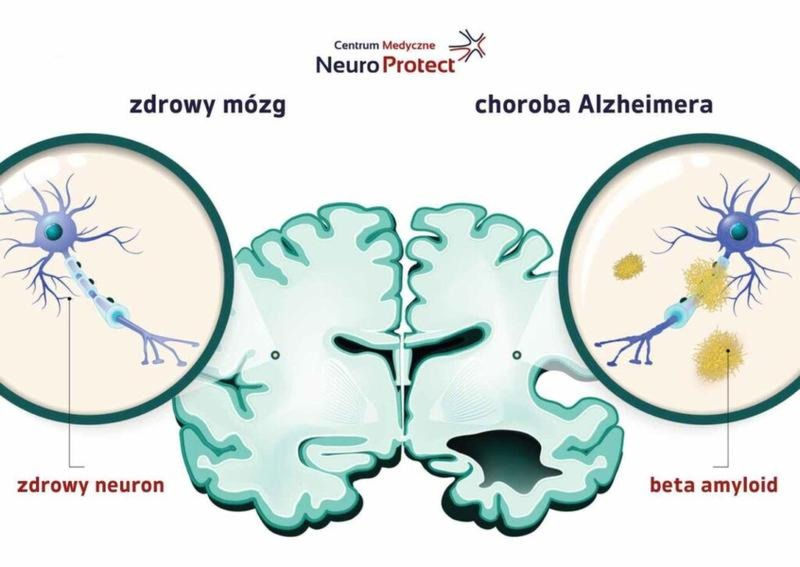 Białko tau a zdrowie mózgu – co wspiera pamięć i neurony?