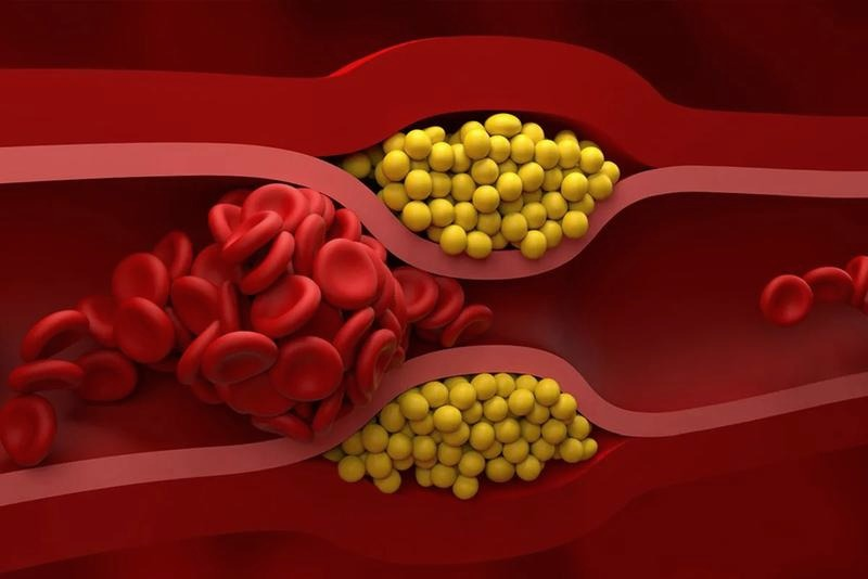 Cholesterol nie-HDL a LDL – dlaczego ma znaczenie i jakie są normy?