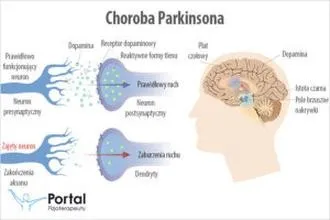 Choroba Parkinsona – objawy, które łatwo przeoczyć, i możliwości leczenia