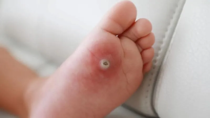 Kurzajka na stopie u dziecka – jak ją rozpoznać i bezpiecznie leczyć?