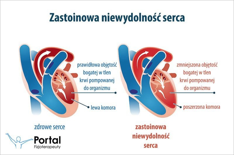 Niewydolność serca: objawy, diagnostyka i skuteczne leczenie