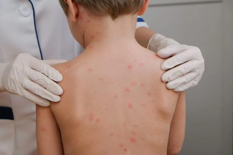 Początek ospy wietrznej: pierwsze objawy i ich kolejność