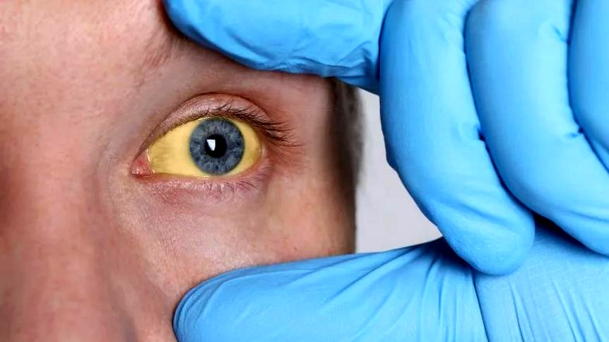 Żółtaczka: jakie badania zrobić i co oznaczają wyniki?