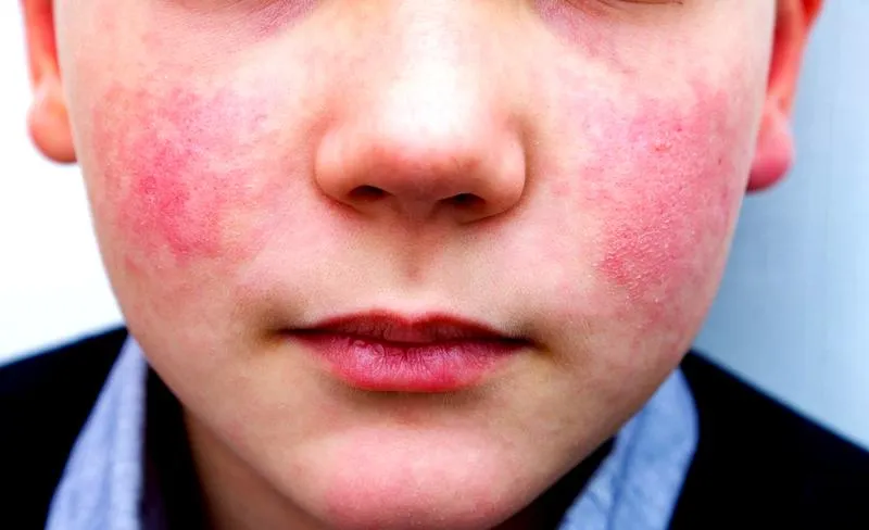 Choroba autoimmunologiczna