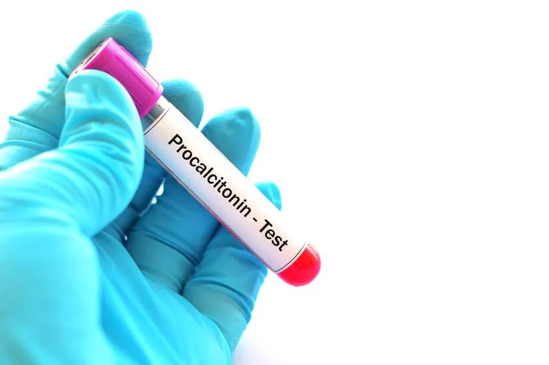 Diagnostyka sepsy prokalcytonina