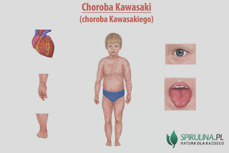 Diagnoza i leczenie choroby Kawasakiego