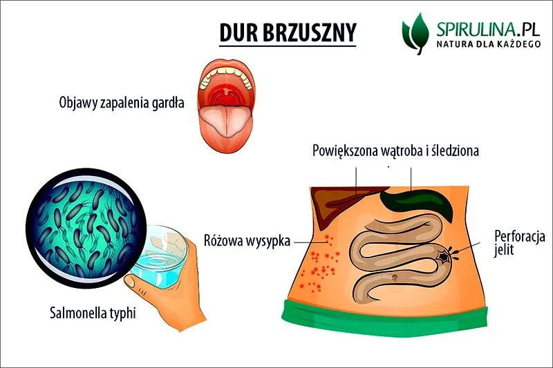 Dur brzuszny objawy