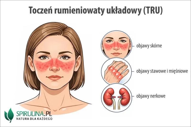 Objawy tocznia rumieniowatego