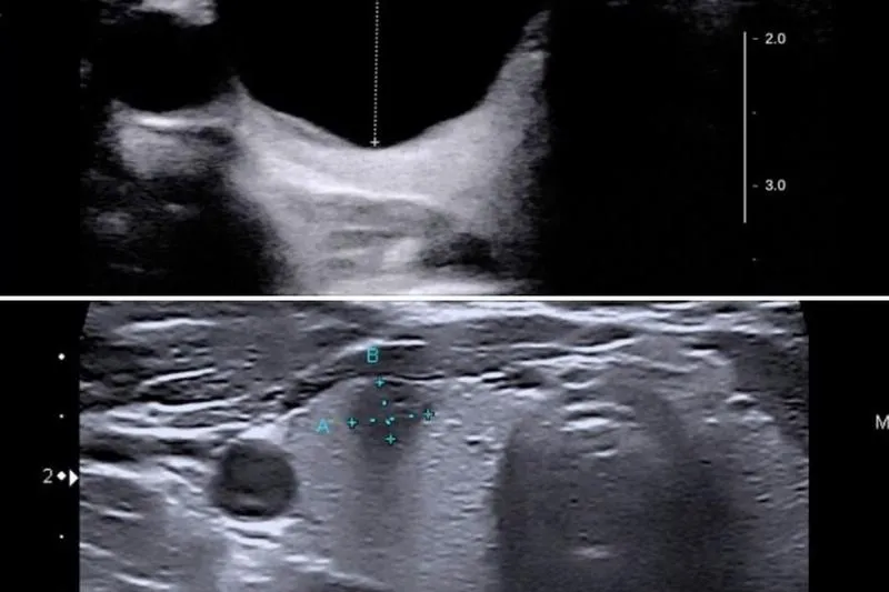 Profilaktyka osteoporozy