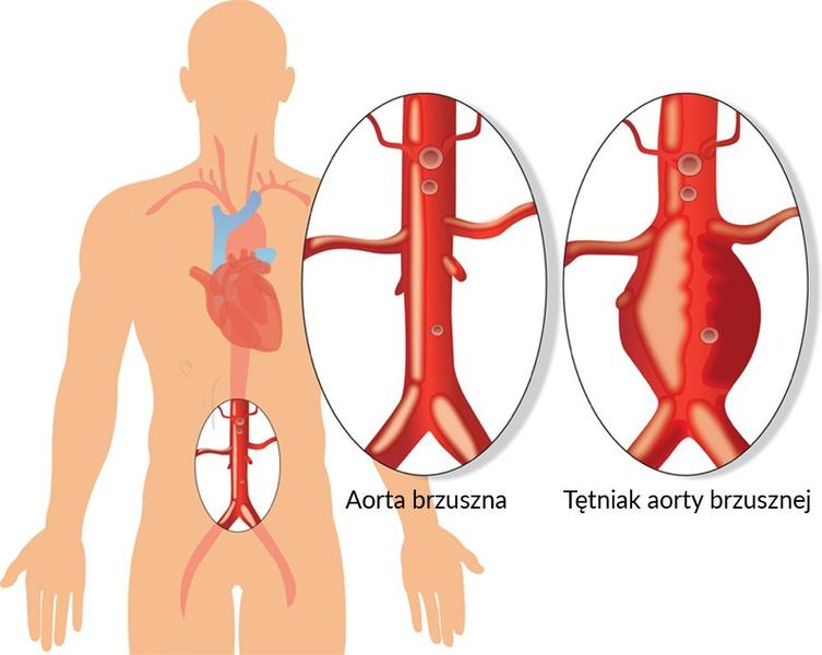 USG aorty brzusznej