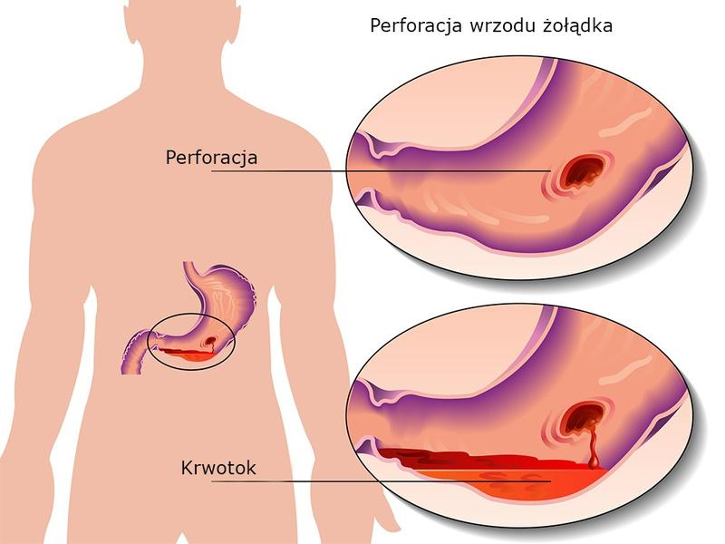 Wrzody żołądka