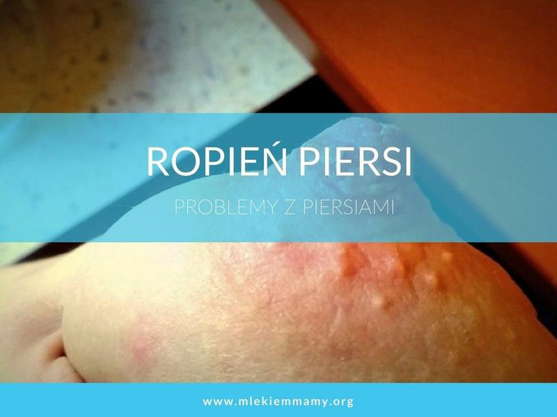 Zapalenie piersi