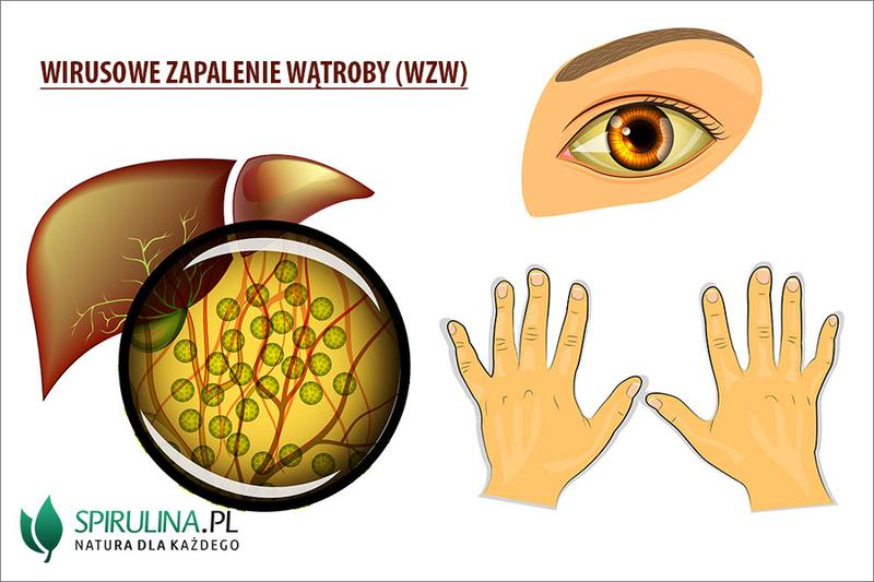 Zapalenie wątroby