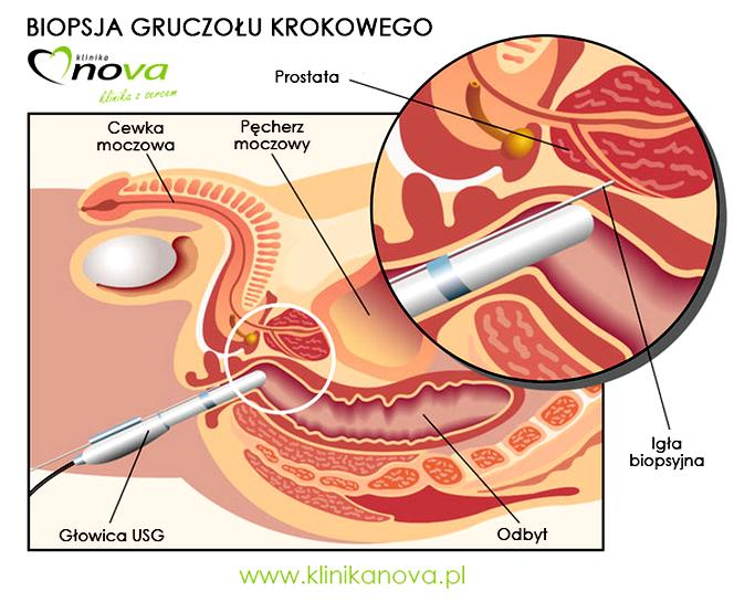 Znieczulenie podczas biopsji
